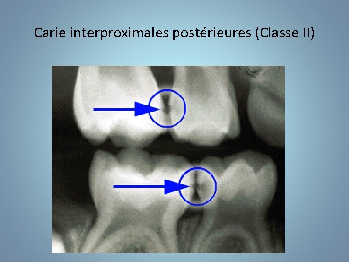 Carie interproximales postérieures (Classe II) 