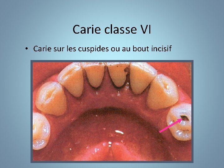 Carie classe VI • Carie sur les cuspides ou au bout incisif 