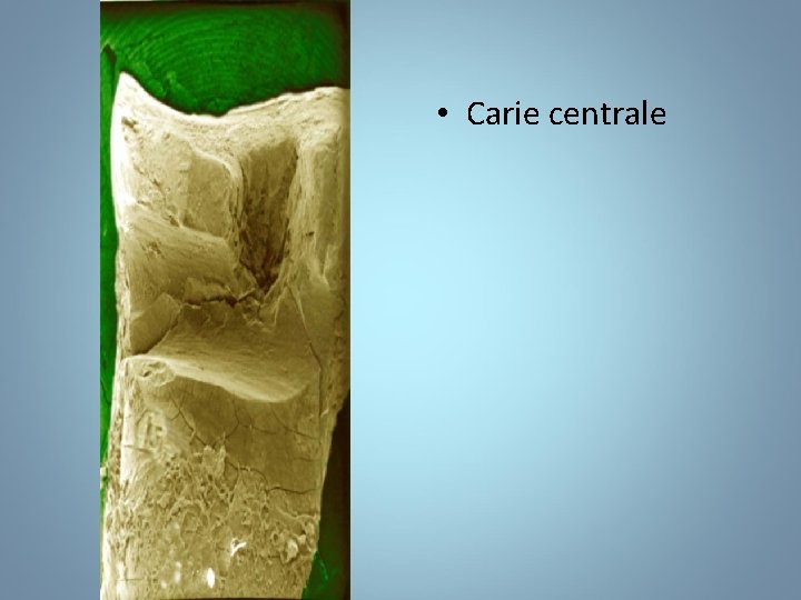  • Carie centrale 