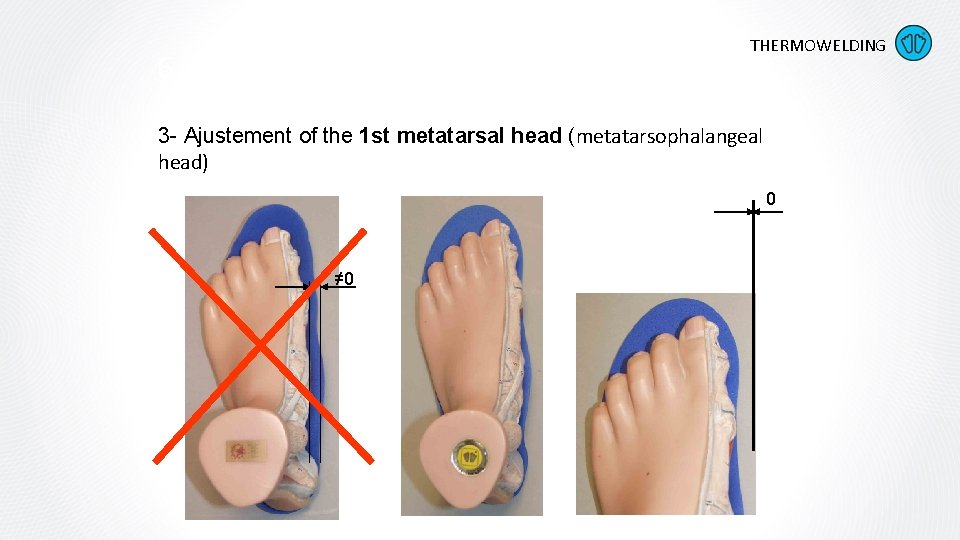 6. Five key points THERMOWELDING 3 - Ajustement of the 1 st metatarsal head