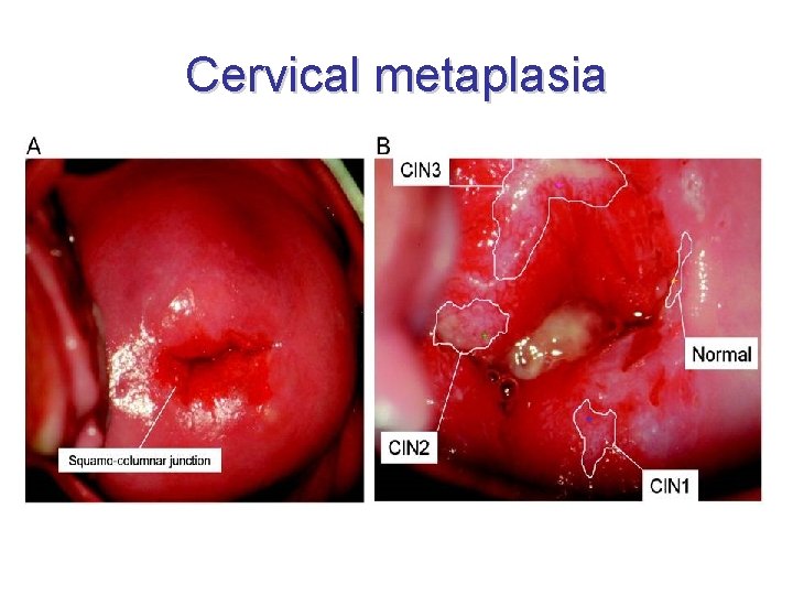 Cervical metaplasia 