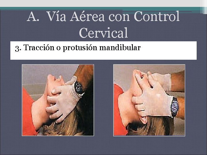A. Vía Aérea con Control Cervical 3. Tracción o protusión mandibular A. Vía Aérea con Control Cervical 3. Tracción o protusión mandibular