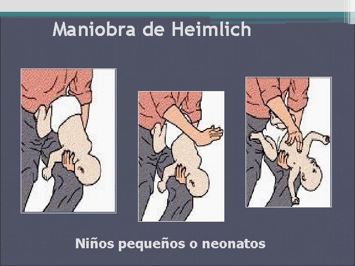 Maniobra de Heimlich Niños pequeños o neonatos 