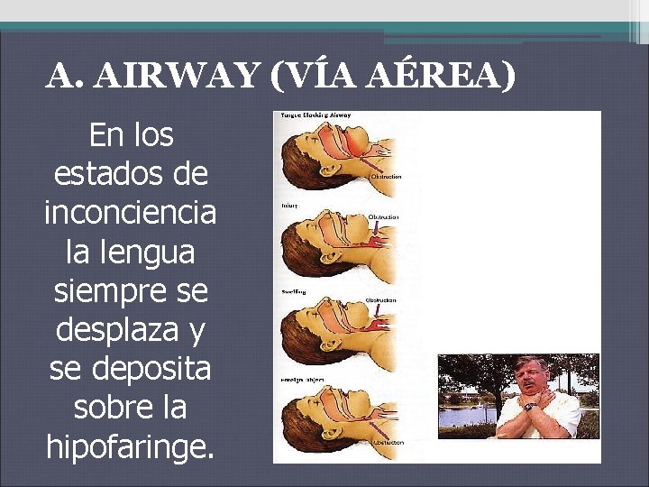 A. AIRWAY (VÍA AÉREA) En los estados de inconciencia la lengua siempre se desplaza A. AIRWAY (VÍA AÉREA) En los estados de inconciencia la lengua siempre se desplaza