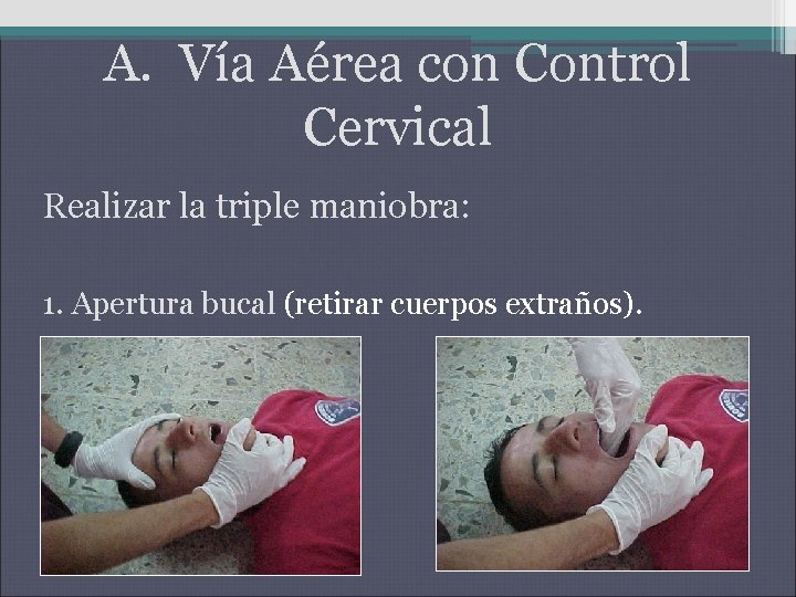 A. Vía Aérea con Control Cervical Realizar la triple maniobra: 1. Apertura bucal (retirar