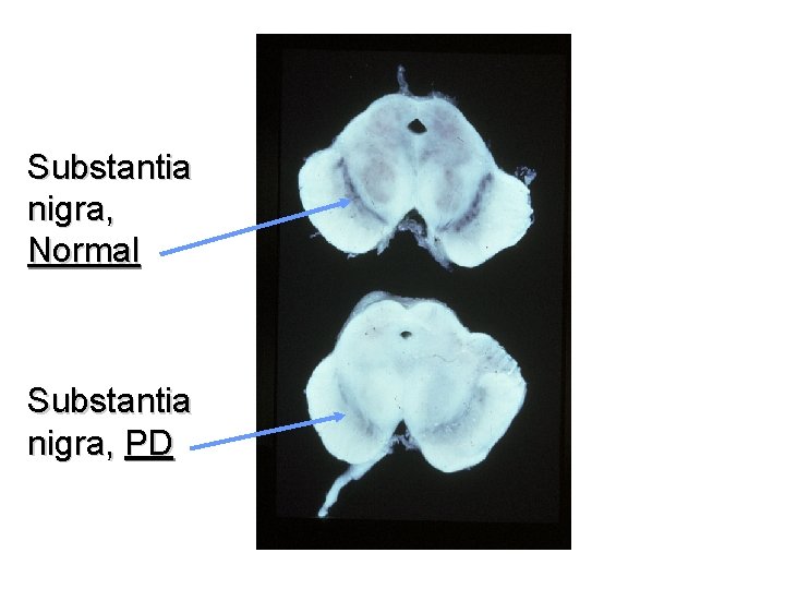 Substantia nigra, Normal Substantia nigra, PD 