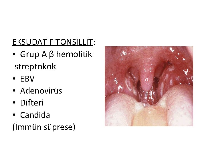 EKSUDATİF TONSİLLİT: • Grup A β hemolitik streptokok • EBV • Adenovirüs • Difteri