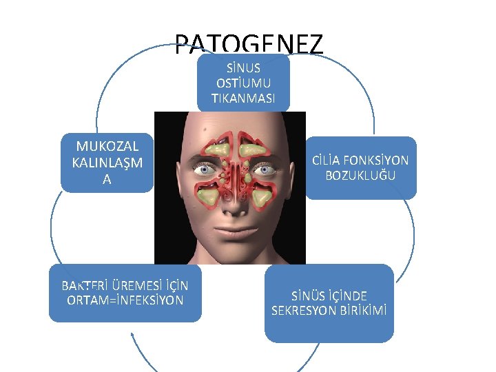 PATOGENEZ SİNUS OSTİUMU TIKANMASI MUKOZAL KALINLAŞM A BAKTERİ ÜREMESİ İÇİN ORTAM=İNFEKSİYON CİLİA FONKSİYON BOZUKLUĞU