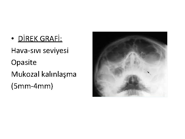  • DİREK GRAFİ: Hava-sıvı seviyesi Opasite Mukozal kalınlaşma (5 mm-4 mm) 