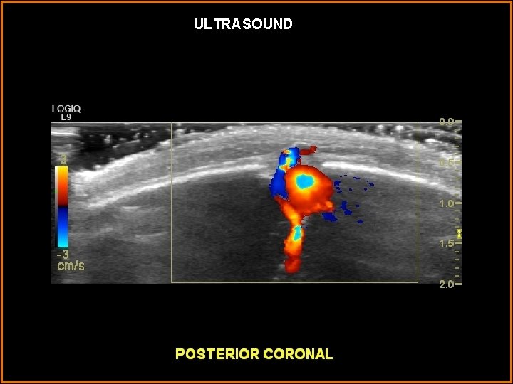 ULTRASOUND 