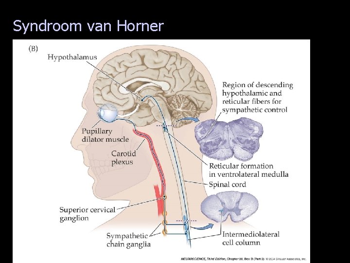 Syndroom van Horner 