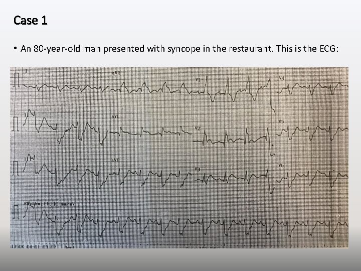 Case 1 • An 80 -year-old man presented with syncope in the restaurant. This