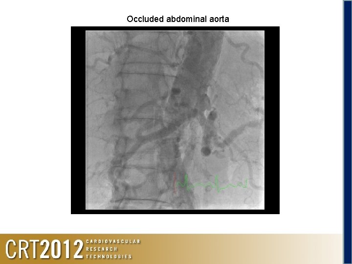 Occluded abdominal aorta Abdominal aorta occlusion 