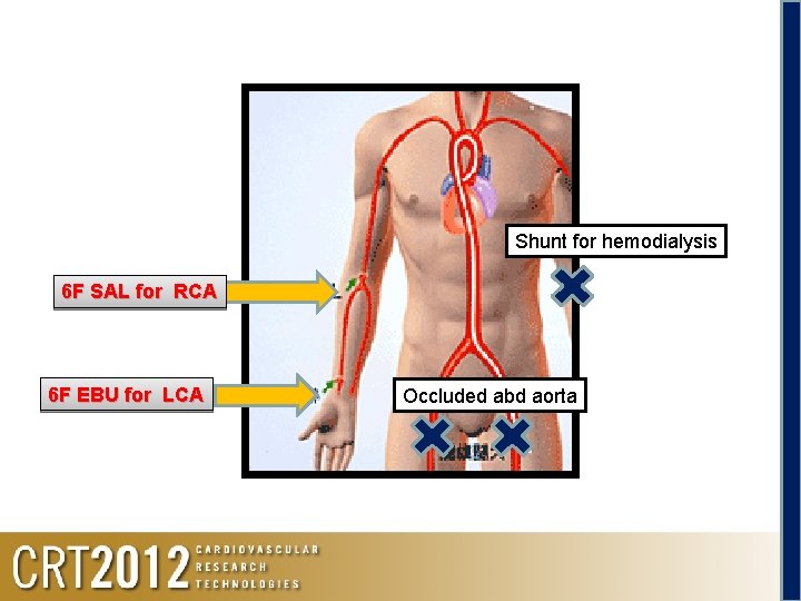 Shunt for hemodialysis 6 F SAL for RCA 6 F EBU for LCA Occluded