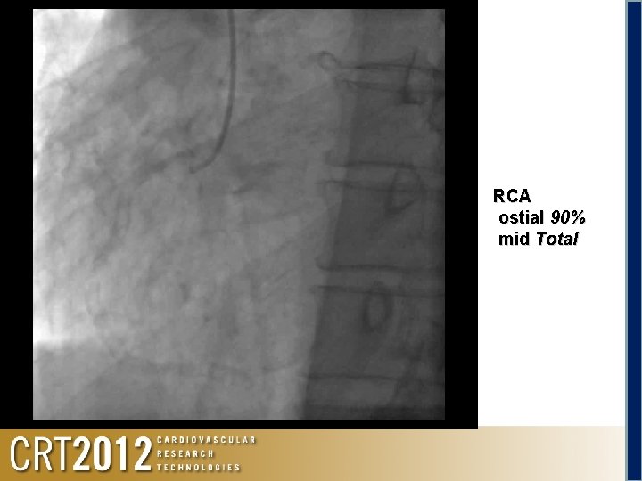 Angio RCA ostial 90% mid Total 