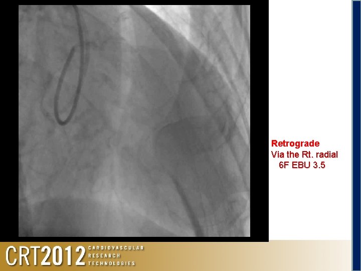 Angio LCA Retrograde Via the Rt. radial 6 F EBU 3. 5 
