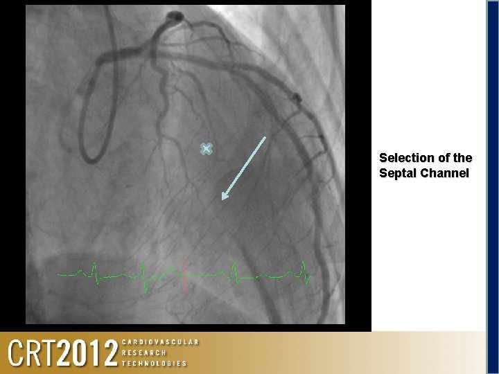 Selection of the Septal Channel 
