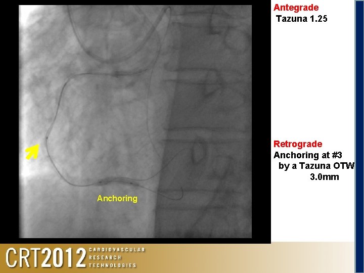 Antegrade Tazuna 1. 25 Retrograde Anchoring at #3 by a Tazuna OTW 3. 0