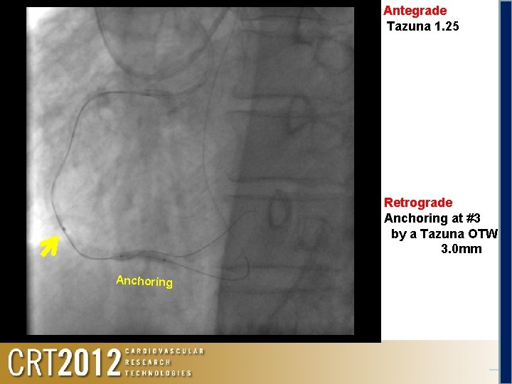 Antegrade Tazuna 1. 25 Retrograde Anchoring at #3 by a Tazuna OTW 3. 0