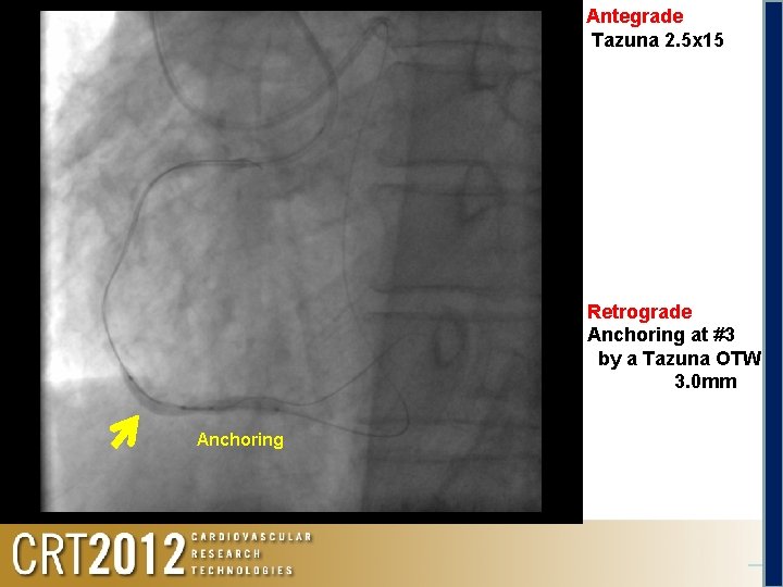 Antegrade Tazuna 2. 5 x 15 Retrograde Anchoring at #3 by a Tazuna OTW