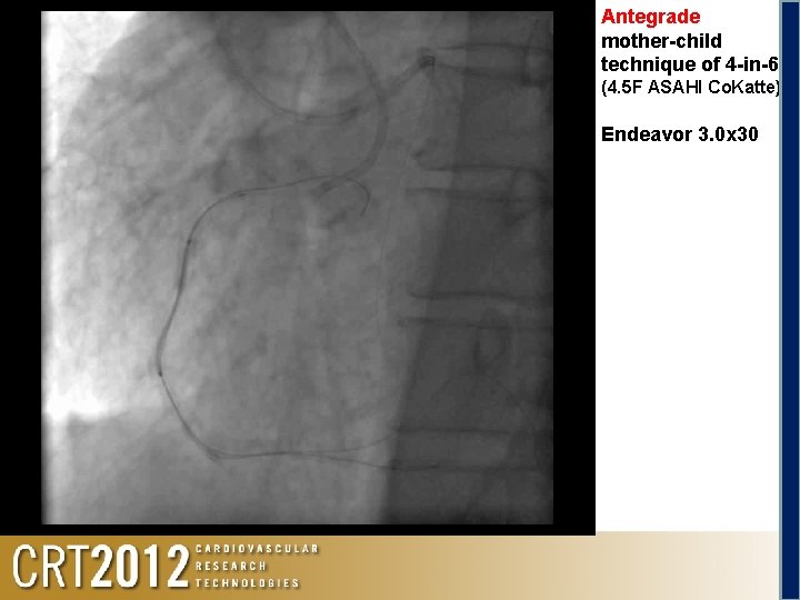 Antegrade mother-child technique of 4 -in-6 (4. 5 F ASAHI Co. Katte) Endeavor 3.