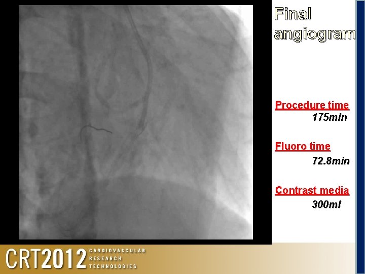 Final angiogram Procedure time 175 min Fluoro time 72. 8 min Contrast media 300