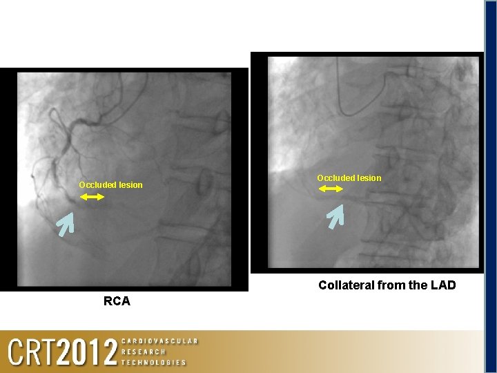 Occluded lesion Collateral from the LAD RCA 