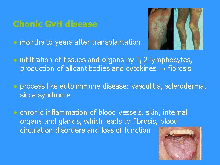 Chonic Gv. H disease ● months to years after transplantation ● infiltration of tissues