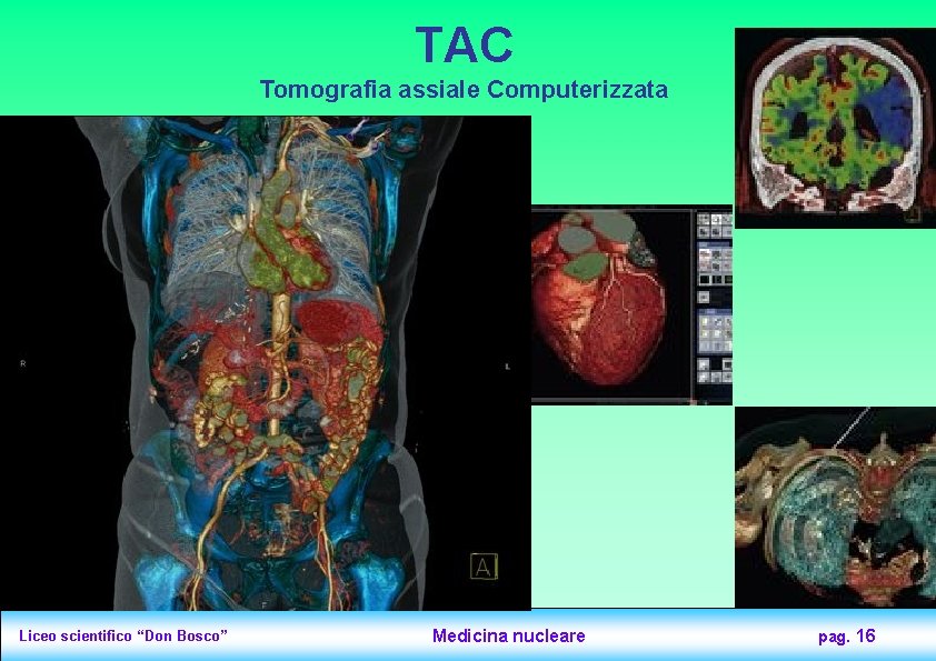 TAC Tomografia assiale Computerizzata Liceo scientifico “Don Bosco” Medicina nucleare pag. 16 