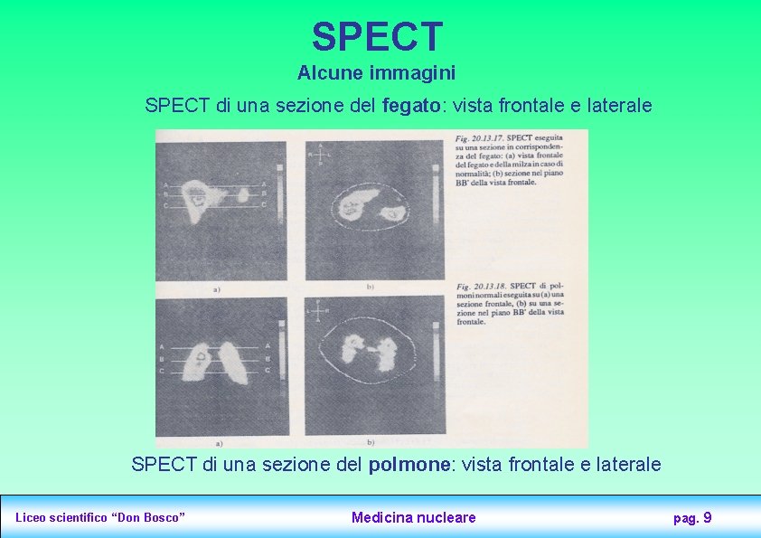 SPECT Alcune immagini SPECT di una sezione del fegato: vista frontale e laterale SPECT