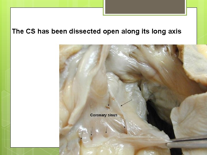 The CS has been dissected open along its long axis 