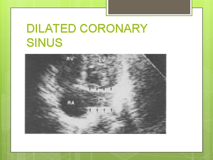 DILATED CORONARY SINUS 