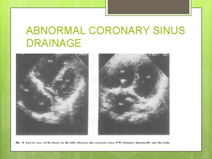 ABNORMAL CORONARY SINUS DRAINAGE 