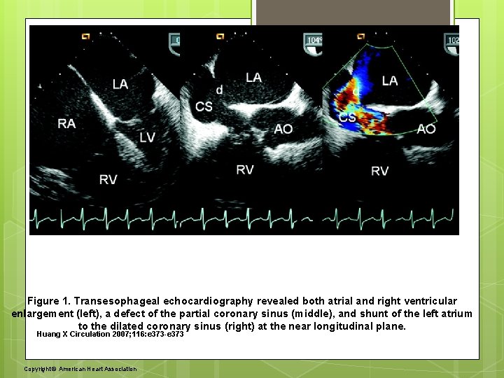 Figure 1. Transesophageal echocardiography revealed both atrial and right ventricular enlargement (left), a defect
