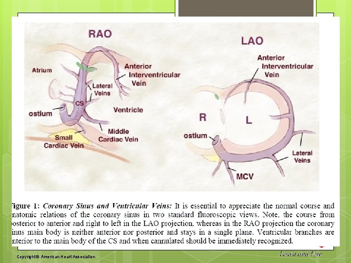 Figure 2. A partial coronary sinus defect beyond the range of the interatrial septum