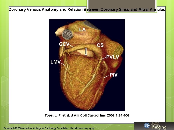 Coronary Venous Anatomy and Relation Between Coronary Sinus and Mitral Annulus Tops, L. F.