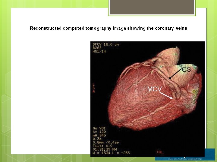 Reconstructed computed tomography image showing the coronary veins 