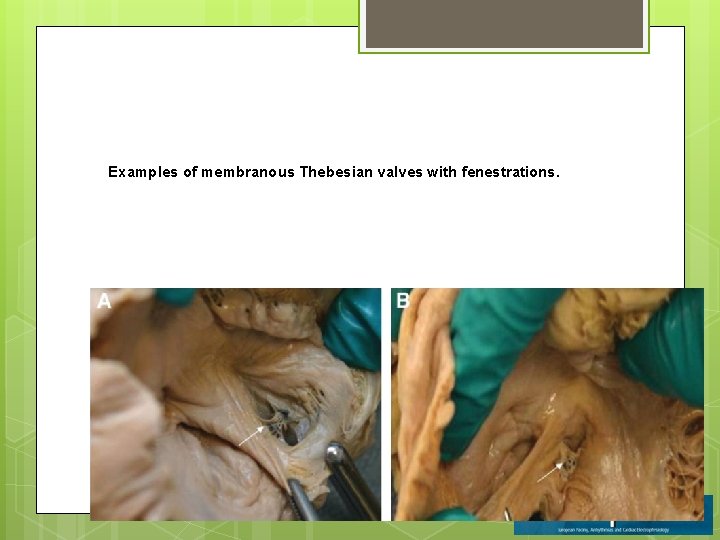 Examples of membranous Thebesian valves with fenestrations. 