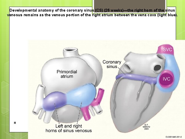 Developmental anatomy of the coronary sinus (CS) (26 weeks)—the right horn of the sinus