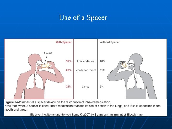 Use of a Spacer 