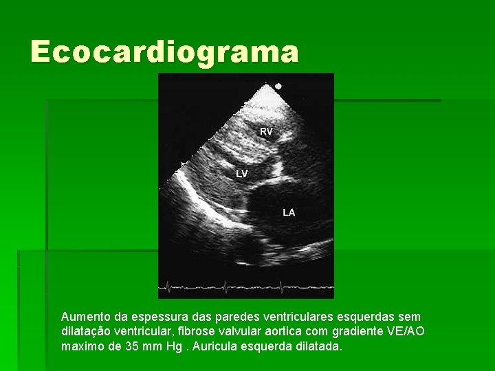 Ecocardiograma Aumento da espessura das paredes ventriculares esquerdas sem dilatação ventricular, fibrose valvular aortica