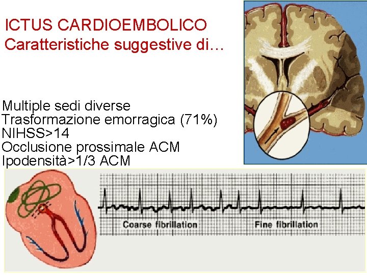 ICTUS CARDIOEMBOLICO Caratteristiche suggestive di… Multiple sedi diverse Trasformazione emorragica (71%) NIHSS>14 Occlusione prossimale