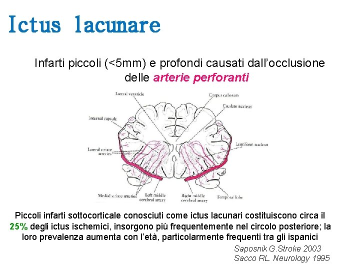 Ictus lacunare Infarti piccoli (<5 mm) e profondi causati dall’occlusione delle arterie perforanti Piccoli