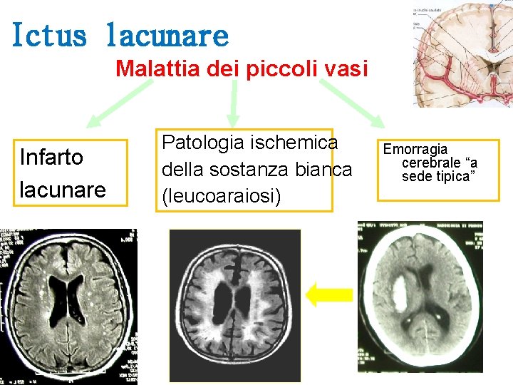 Ictus lacunare Malattia dei piccoli vasi Infarto lacunare Patologia ischemica della sostanza bianca (leucoaraiosi)
