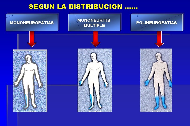 SEGUN LA DISTRIBUCION …… MONONEUROPATIAS MONONEURITIS MULTIPLE POLINEUROPATIAS 