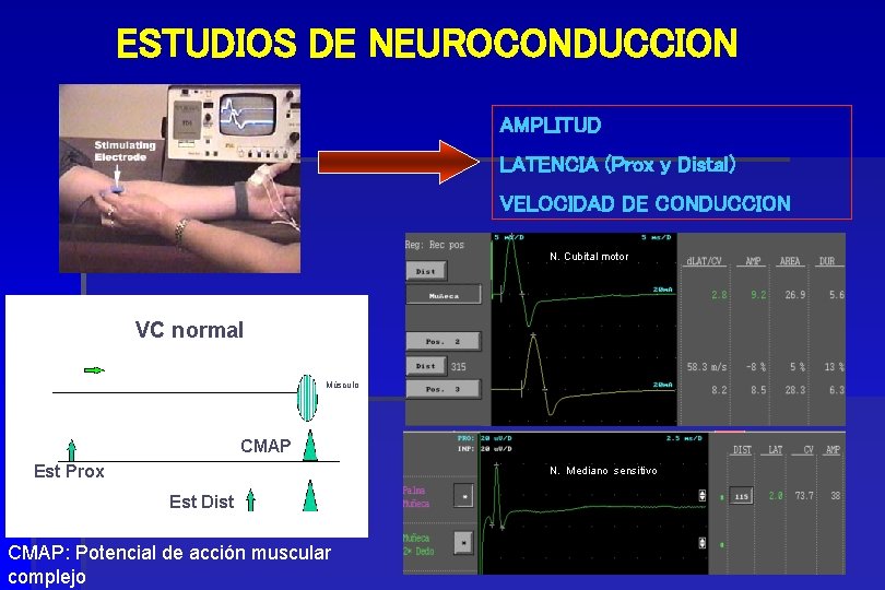 ESTUDIOS DE NEUROCONDUCCION AMPLITUD LATENCIA (Prox y Distal) VELOCIDAD DE CONDUCCION N. Cubital motor