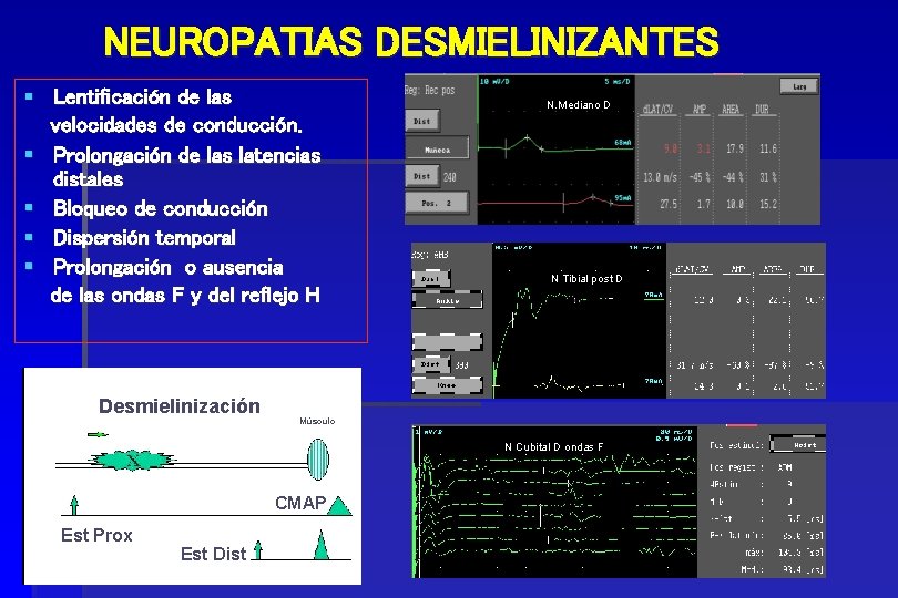 NEUROPATIAS DESMIELINIZANTES § Lentificación de las velocidades de conducción. § Prolongación de las latencias