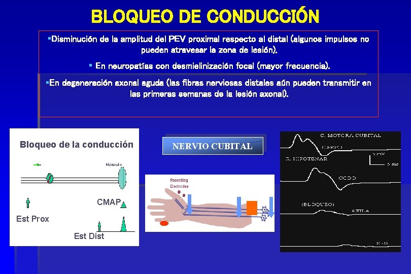 BLOQUEO DE CONDUCCIÓN §Disminución de la amplitud del PEV proximal respecto al distal (algunos