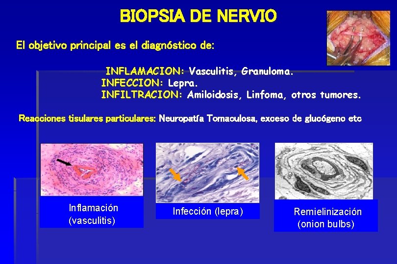 BIOPSIA DE NERVIO El objetivo principal es el diagnóstico de: INFLAMACION: Vasculitis, Granuloma. INFECCION: