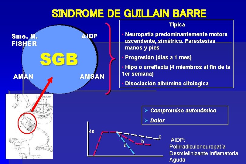 SINDROME DE GUILLAIN BARRE Típica Sme. M. FISHER AMAN AIDP SGB • Neuropatía predominantemente